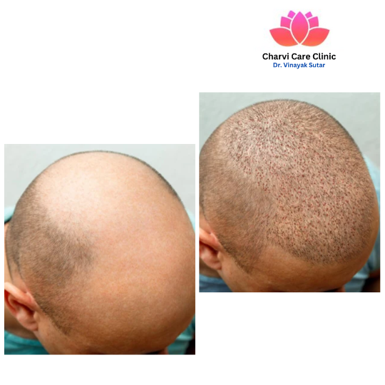Hair Trasplant (1)