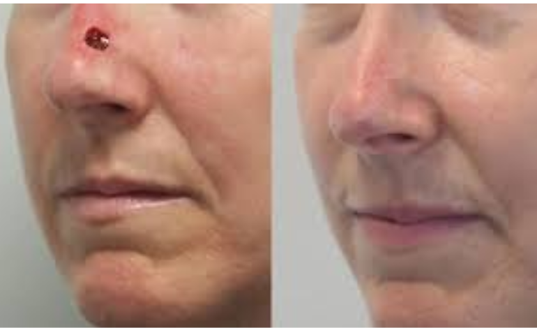 Cancer Reconstruction